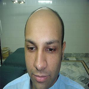 Hair Transplant After