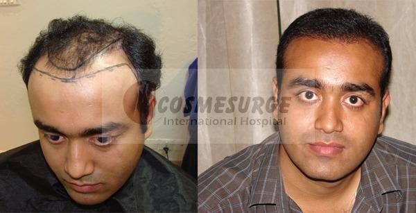 Hair Transplant in Islamabad (FUE, FUT, SMP, PRP) - Cosmesurge