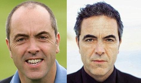 hair Transplant benefits and side effects