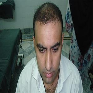 Hair Transplant in Rawalpindi, Islamabad and Pakistan results