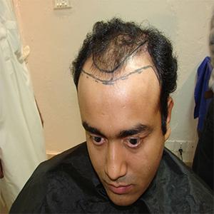 Hair Transplant in Rawalpindi, Islamabad and Pakistan results