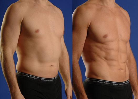 liposuction in Islamabad, Rawalpindi, Peshawar & Pakistan