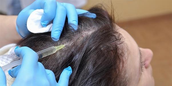 PRP hair treatment in Islamabad, Rawalpindi and Pakistan