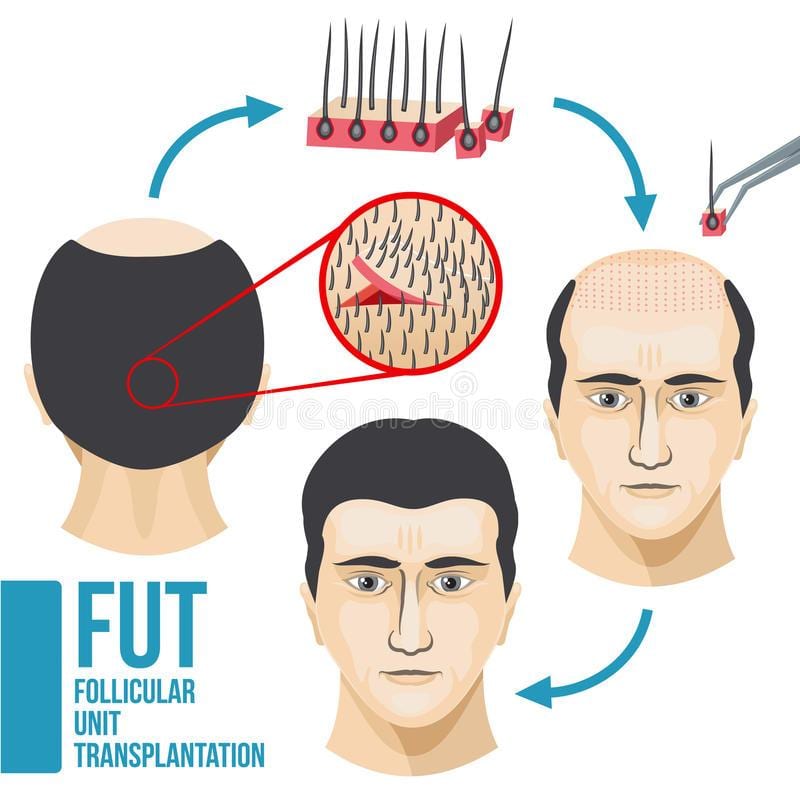 FUT Hair Transplant in Rawalpindi, Islamabad and Pakistan