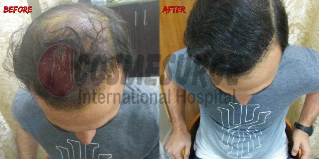 smp scalp micropigmentation in Rawalpindi & Islamabad