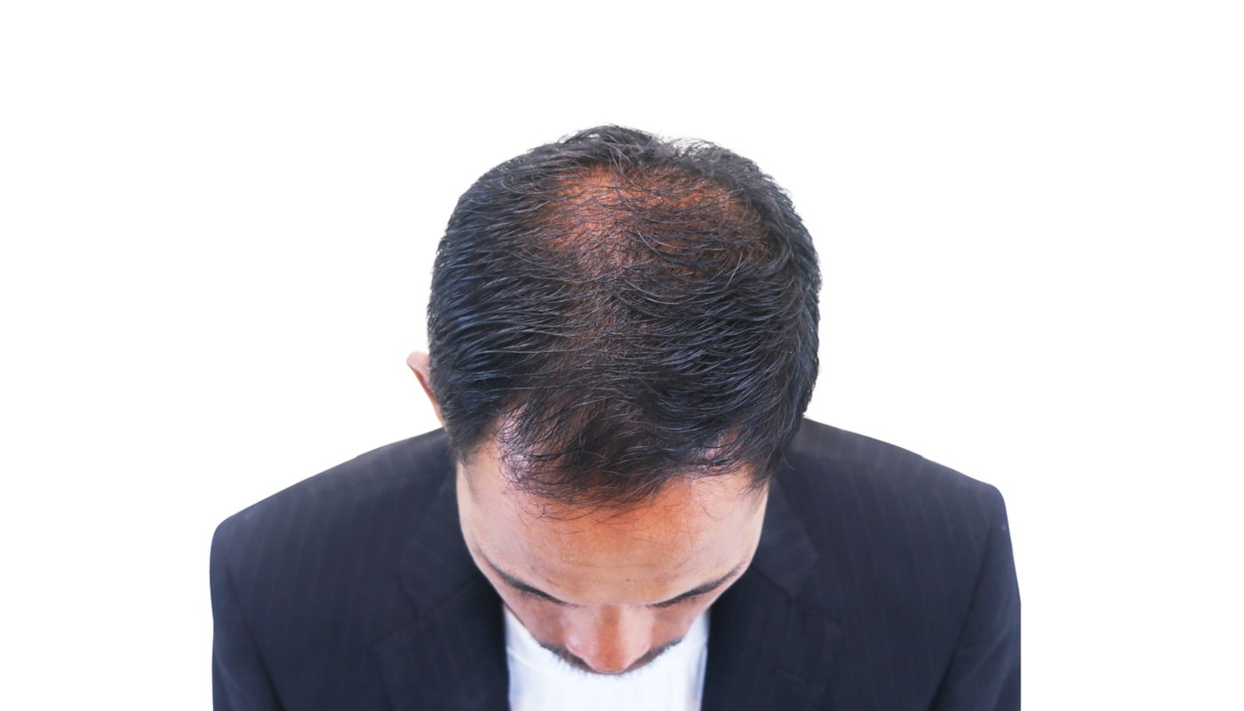 Do and Don'ts after Hair Transplant
