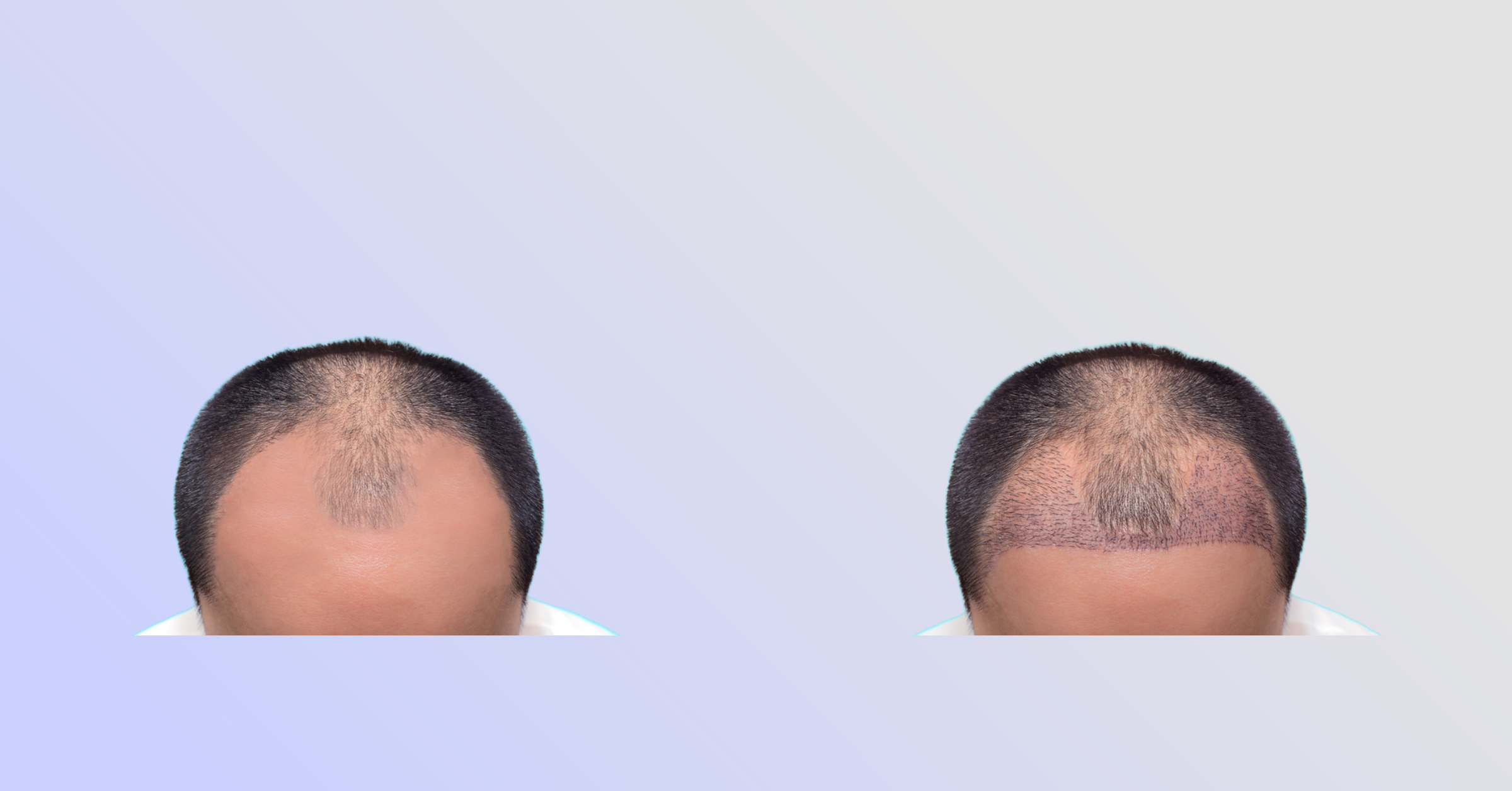 Ice FUE Hair Transplant